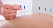 ¿Cómo funciona la acupuntura?